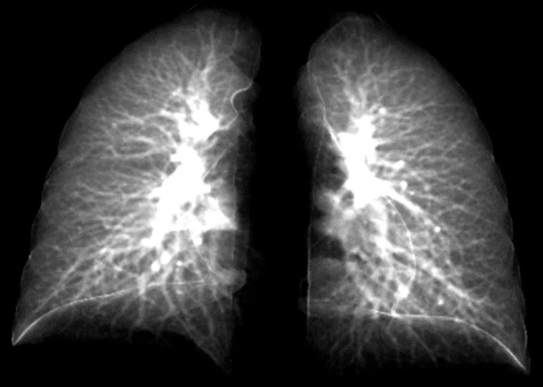 تصویر برداری اشعه ایکس از ریه ها